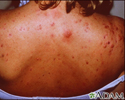 Acne nas costas