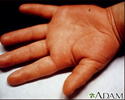 Doença de Kawasaki- edema da mão