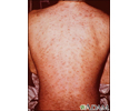 Drug rash on the back