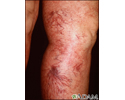 Telangiectasia - pernas