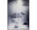 Obstrução do intestino delgado - raio X