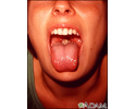 Mononucleose - boca