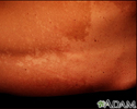 Tinea versicolor - costas