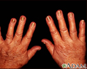 Unhas amarelas