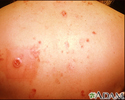 Câncer de múltiplas células basais devido à terapia de raio X para acne