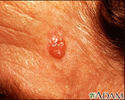 Carcinoma basocelular - face