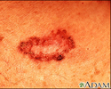Carcinoma basocelular - imagem detalhada
