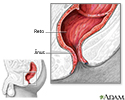 Cirurgia de hemorroidas - série