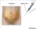 Amostra peritoneal