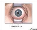 Coloboma da íris