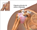 Inflamação na articulação do ombro