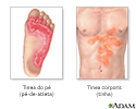 Tinea (tinha)