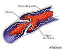 Coágulo de sangue venoso