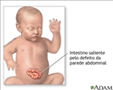 Hérnia abdominal (gastrosquise) em bebês