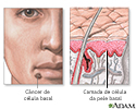 Câncer basocelular