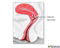 Câncer cervical