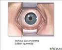 Quemose