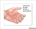 Deformidade por contratura