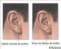 Prega no lóbulo