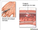 Coágulos sanguíneos