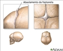 Fontanelas protuberantes