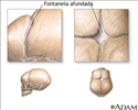 Fontanelas afundadas (vista superior)