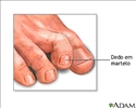 Hammer toe (deformação do dedo do pé)