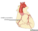 Enfermedad de las arterias coronarias