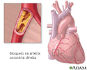 Bloqueio arterial coronariano