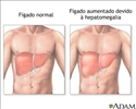Hepatomegalia