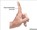 Articulações hipermóveis