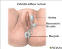Esfíncter artificial inflável