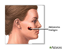Melanoma maligno