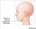 Nódulo no pescoço
