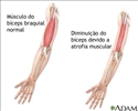 Atrofia muscular