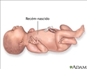 Neonato