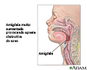 Apneia obstrutiva do sono