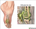 Osteomielite