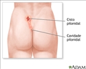 Covinha e cisto pilonidal