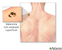 Melanoma