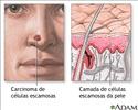 Câncer das células escamosas