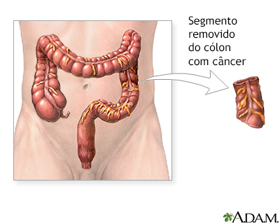 cancer de colon uruguay