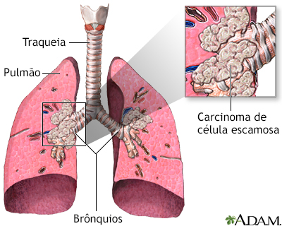 Resultado de imagem para Carcinoma de células escamosas