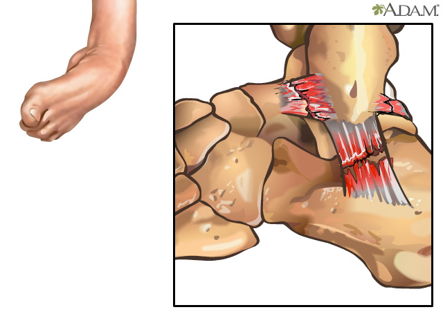 Ankle ligament injury