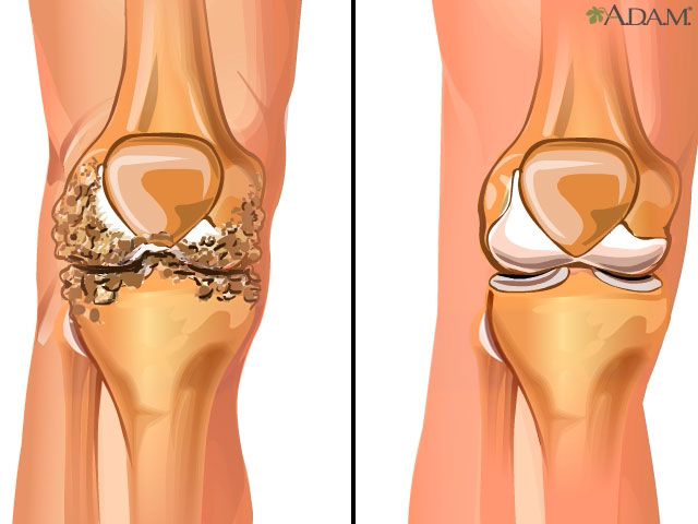 Osteoarthritis