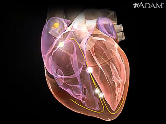 Arrhythmias