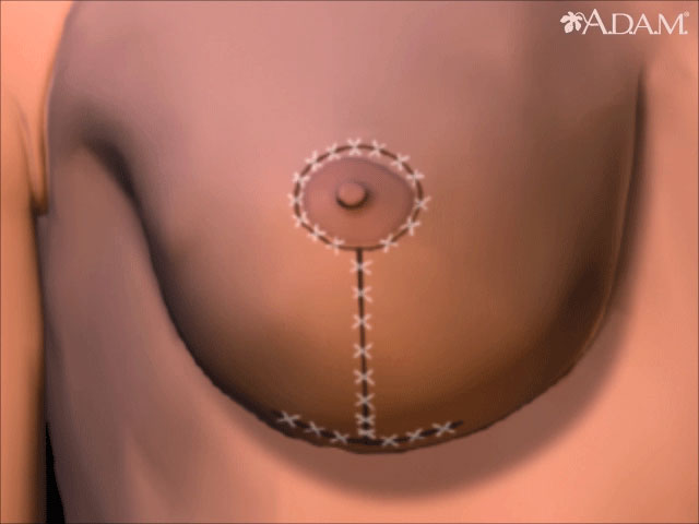 Breast lift