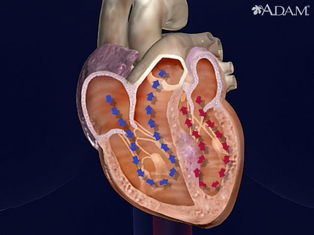 Cardiomyopathy