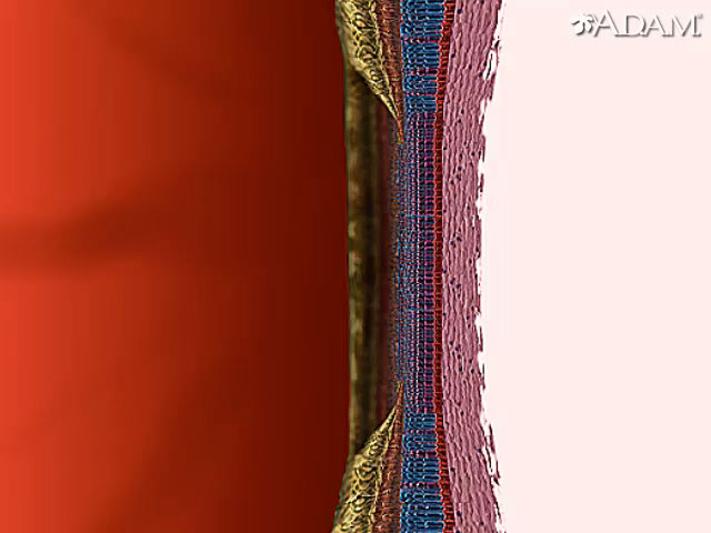 Macular degeneration