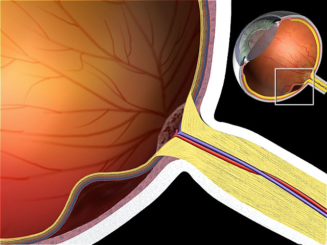 Retinal detachment
